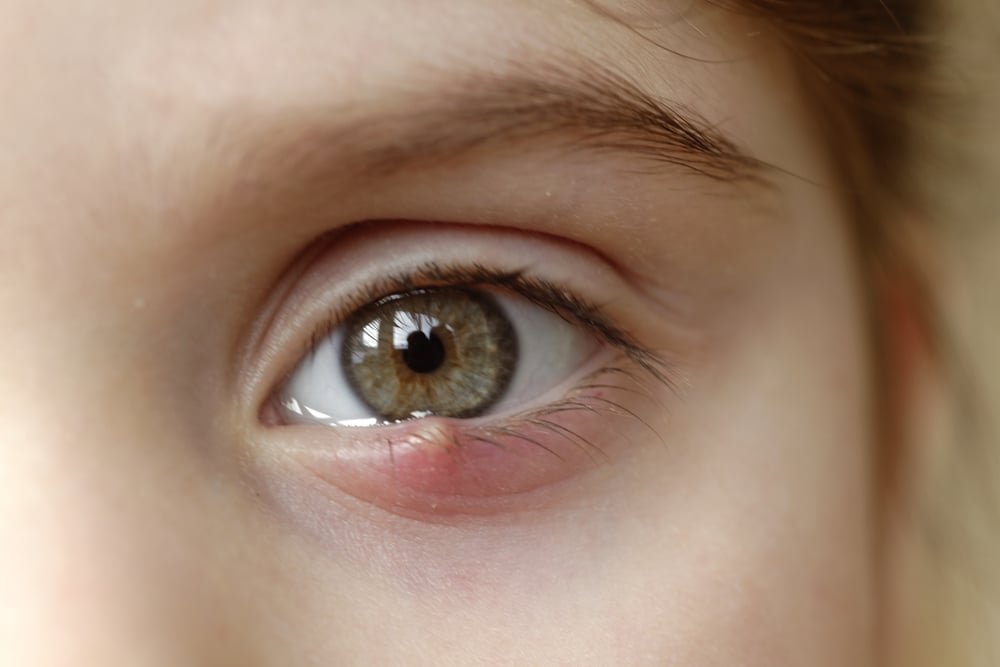 orzuelo ¿Por qué salen los orzuelos en los ojos y cómo prevenirlos?