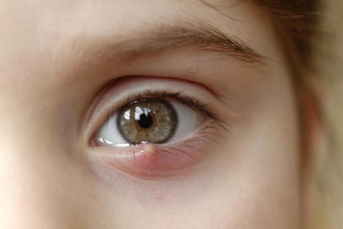 orzuelo ¿Por qué salen los orzuelos en los ojos y cómo prevenirlos?