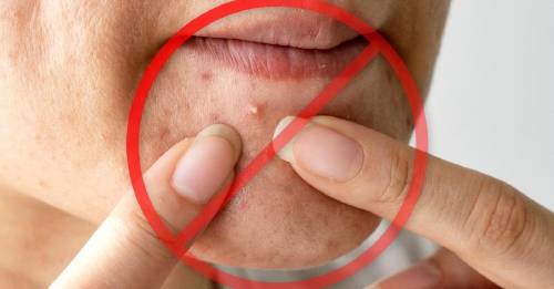 5 errores jamas deberias cometer acne