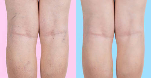 ejercicios para mantener a raya tus varices ejercicios para mantener a raya tus varices