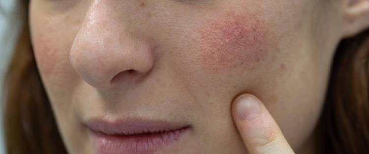 Cara enrojecida por el alcohol Cara enrojecida por el alcohol