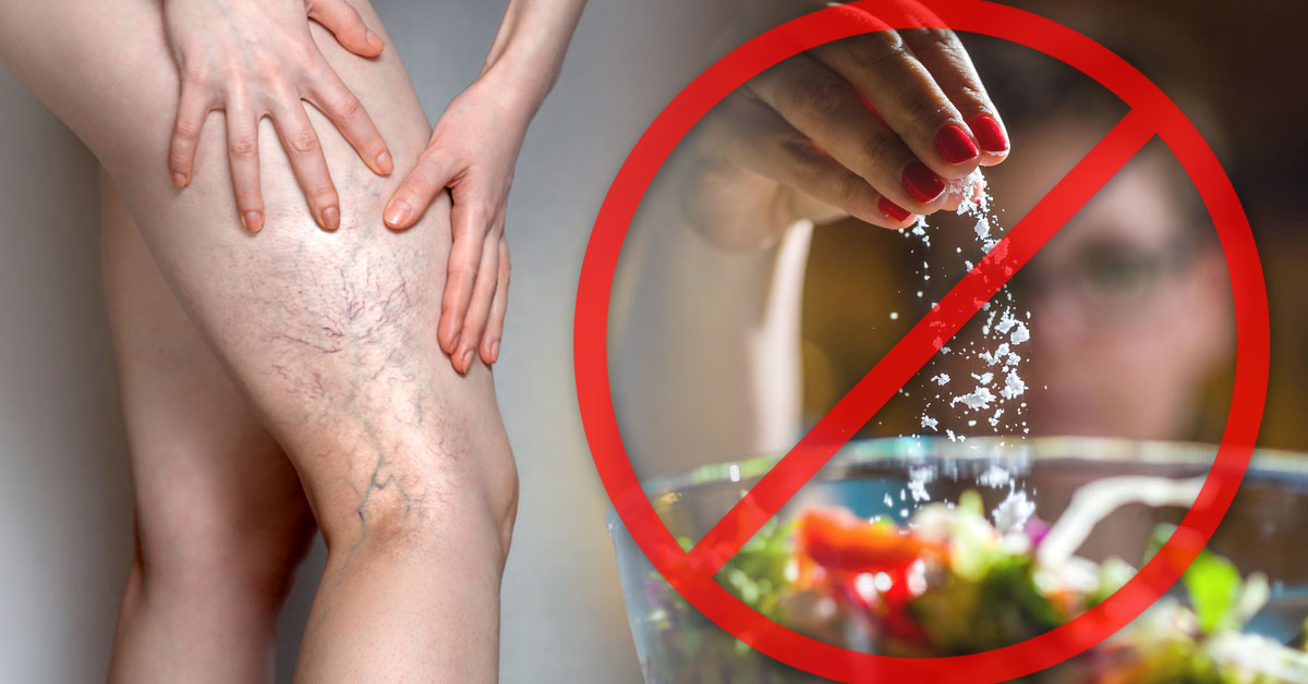 Cosas que debes evitar para prevenir las varices evitar la sala para prevenir varices