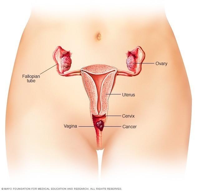 Cuando el cáncer de vagina es pequeño y sólo se encuentra en las células que revisten la vagina, puede que no cause síntomas Cuando el cáncer de vagina es pequeño y sólo se encuentra en las células que revisten la vagina, puede que no cause síntomas