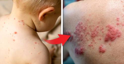 Un virus que quizás tuviste de niño y se vuelve a activar de adulto