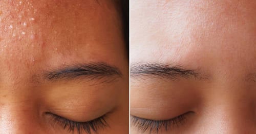 Elimina las marcas y cicatrices de la piel con esta crema de coco y aloe Elimina las marcas y cicatrices de la piel con esta crema de coco y aloe