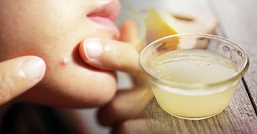 eliminar espinillas limon como eliminar espinillas con bicarbonato de sodio o limon