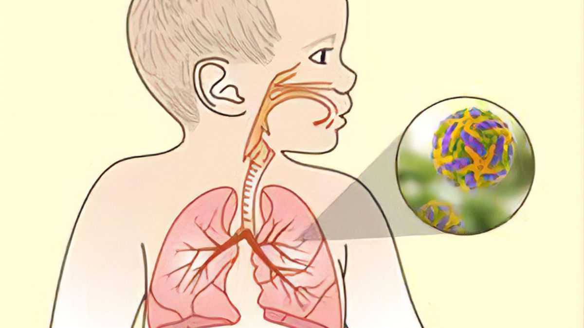 virus respiratorio El VSR tiene una distribución global, pero su impacto es más severo en países de ingresos bajos y medianos. (Foto: https: medicinabasica.com)