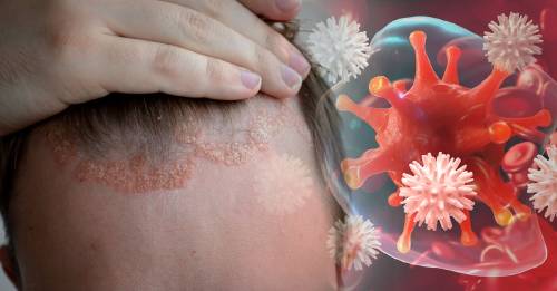 enfermedades autoinmunes cuerpo ataca si mismo Psoriasis enfermedad del alma y su significado emocional