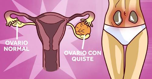 Ovario con quiste