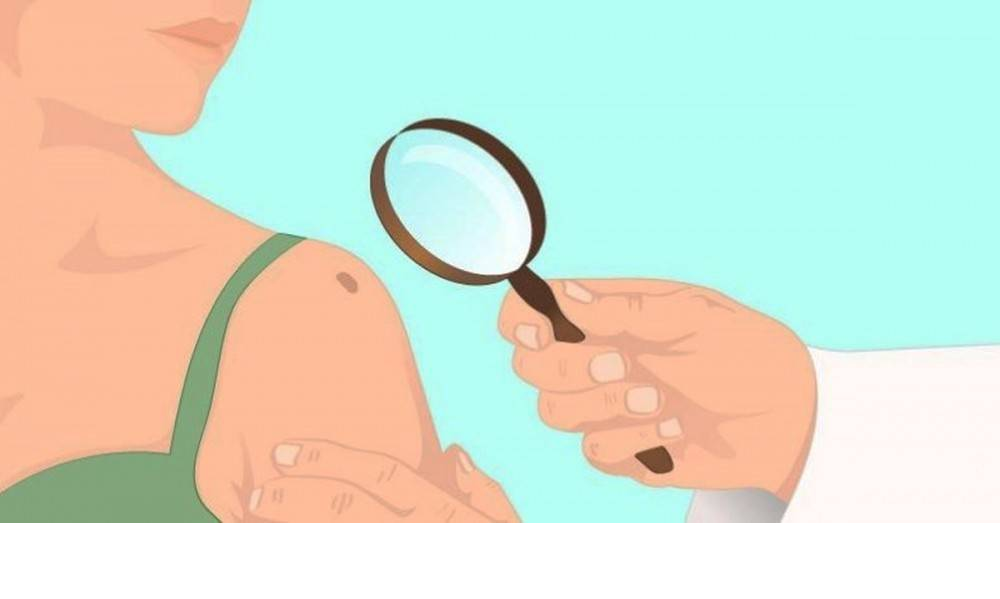 Lunares Lunares malignos