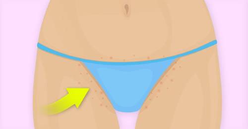 ¿Por qué aparecen esas manchas oscuras en tus zonas íntimas? Esta es la razón y las soluciones ¿Por qué aparecen esas manchas oscuras en tus zonas íntimas? Esta es la razón y las soluciones