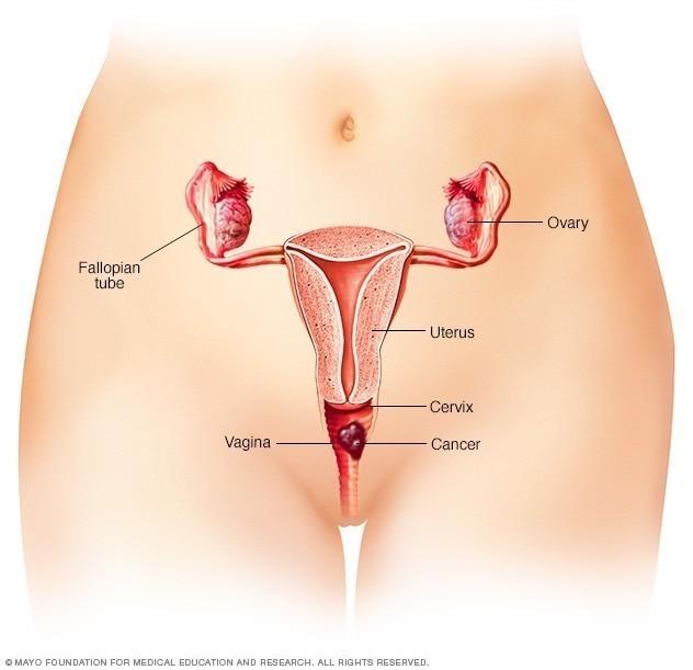 Cuando el cáncer de vagina es pequeño y sólo se encuentra en las células que revisten la vagina, puede que no cause síntomas