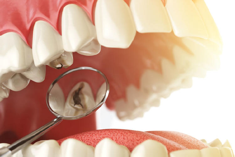 mala salud bucal Estos remedios naturales te ayudarán a eliminar las caries y cuidar tu salud bucal