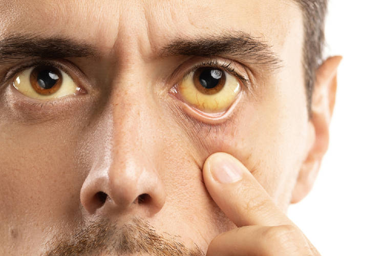 Ojos amarillos: problemas de salud Ojos amarillos: problemas de salud