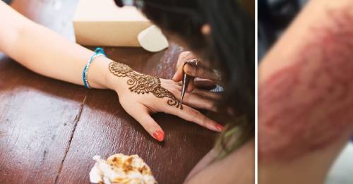 Un tatuaje de henna la dejó cicatrizada para siempre