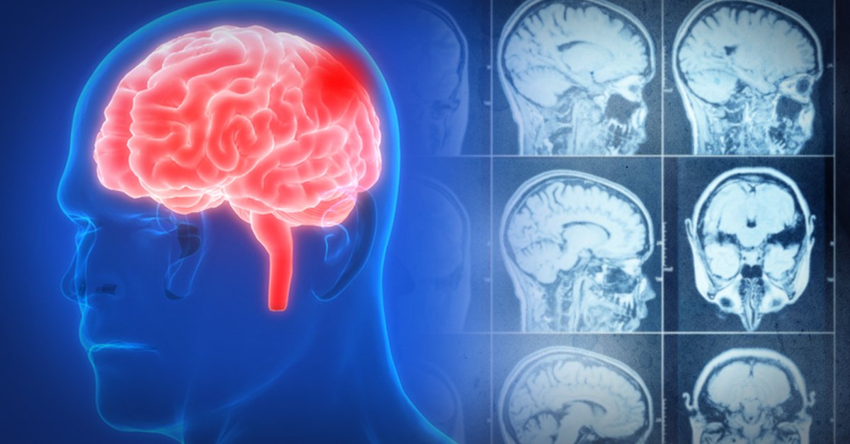7 cosas cotidianas que puedes hacer para reducir el riesgo de un derrame cerebral 7 cosas cotidianas que puedes hacer para reducir el riesgo de un derrame cerebral