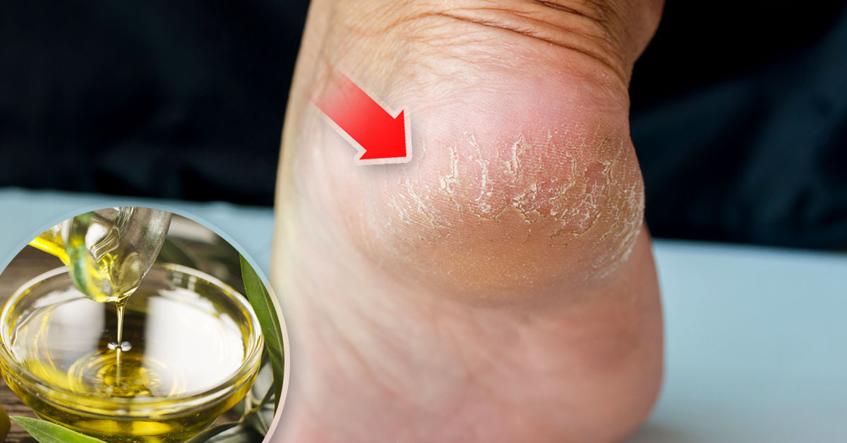 mezcla natural acabara talones secos pies mezcla natural acabara talones secos pies