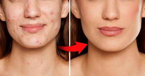 Para evitar el acné, estos 3 pasos no pueden faltar en tu rutina diaria Para evitar el acné, estos 3 pasos no pueden faltar en tu rutina diaria