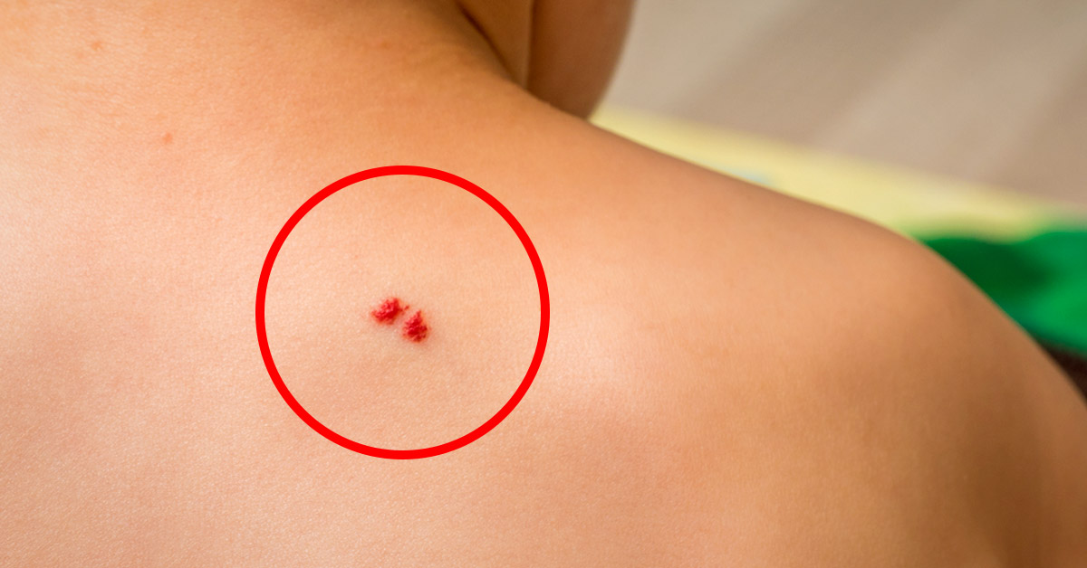 lunares-sangre-deben-preocuparte Lunares rojos en la piel