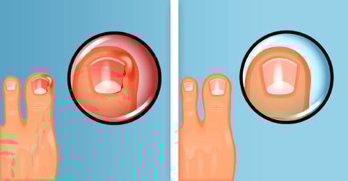 razones encarnan uñas como evitarlo razones encarnan uñas como evitarlo