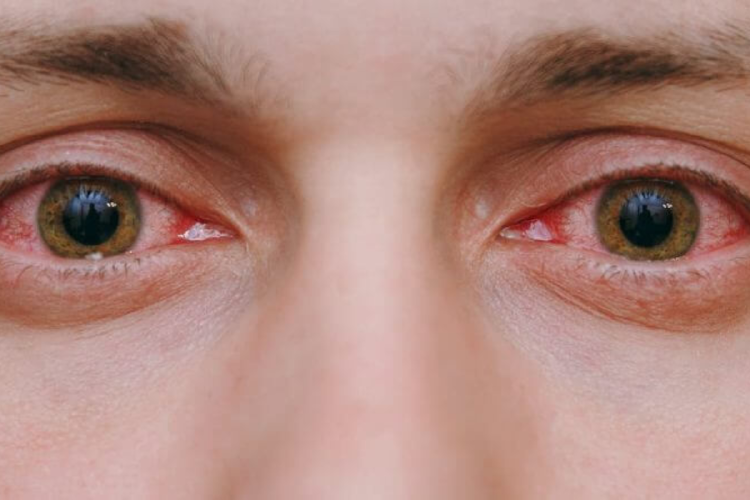 ojos rojos ¿Cómo proteger tu mirada en medio de esta tormenta invisible? Acá te lo contamos. (Imagen: IA)