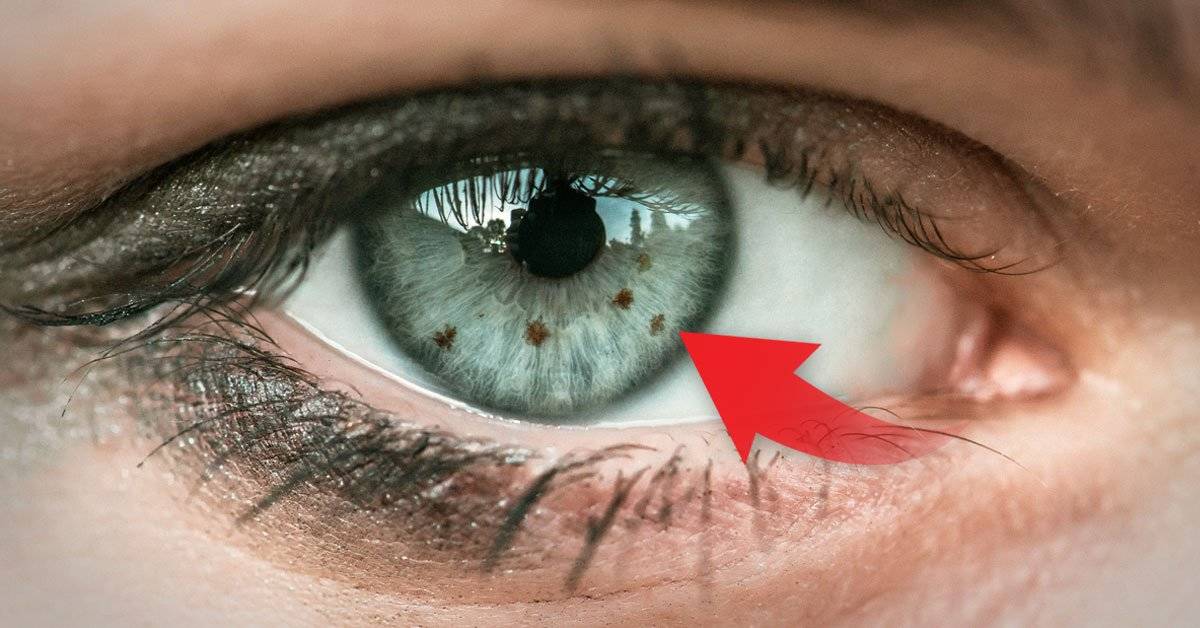 ¿Es malo tener un lunar en el ojo? Bioguia