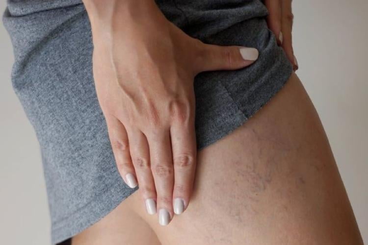 varices Imagen: Pinterest