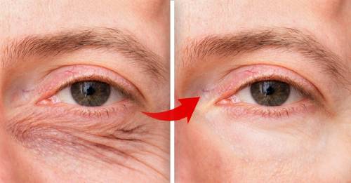 Solución rápida y efectiva para los párpados caídos y arrugas alrededor de los ojos