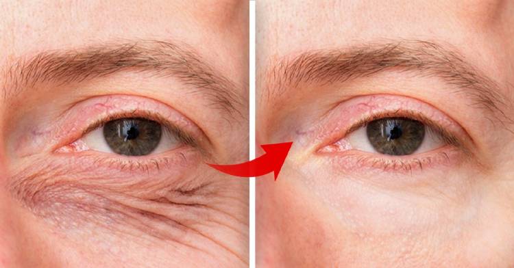 Solución rápida y efectiva para los párpados caídos y arrugas alrededor de los ojos Solución rápida y efectiva para los párpados caídos y arrugas alrededor de los ojos