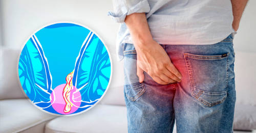 plan emergencia aliviar hemorroides Hombre sufre de hemorroides