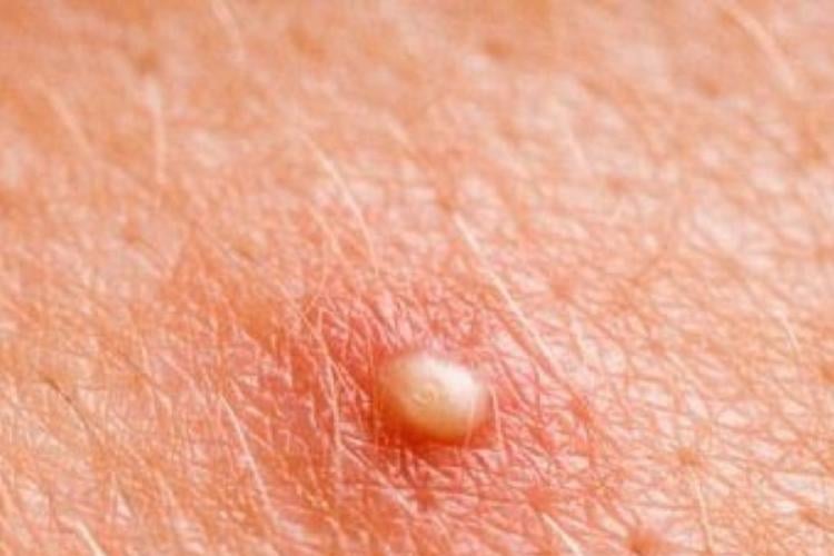 forunculo Los forúnculos son infecciones cutáneas que aparecen como bultos rojos, dolorosos y, en muchos casos, llenos de pus. (PINTEREST)