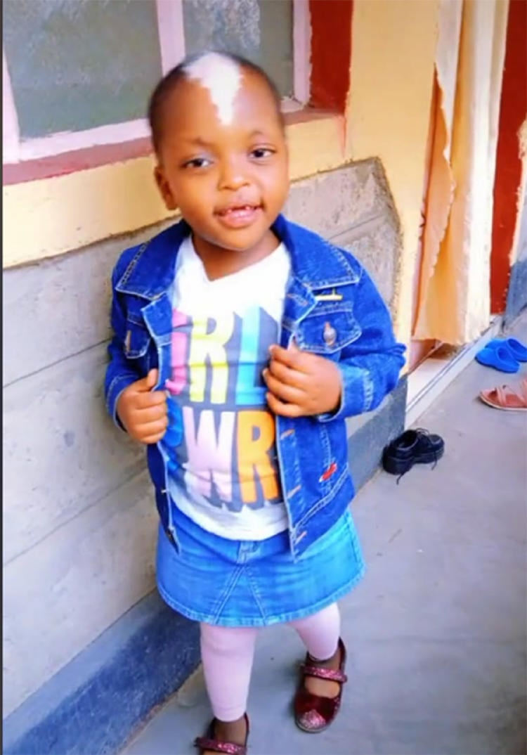 niña mancha blanca3 niña mancha blanca3