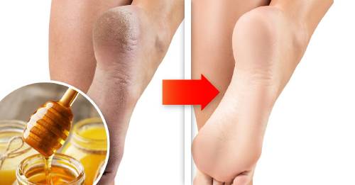 3 tratamientos naturales hidratantes para suavizar la piel de los talones