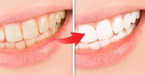 5 ingredientes naturales blanquear dientes al instante