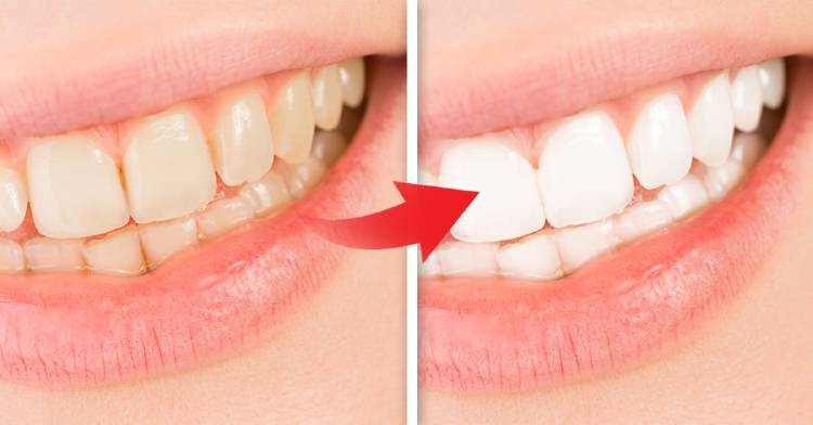 5-ingredientes-naturales-blanquear-dientes-al-instante 5-ingredientes-naturales-blanquear-dientes-al-instante