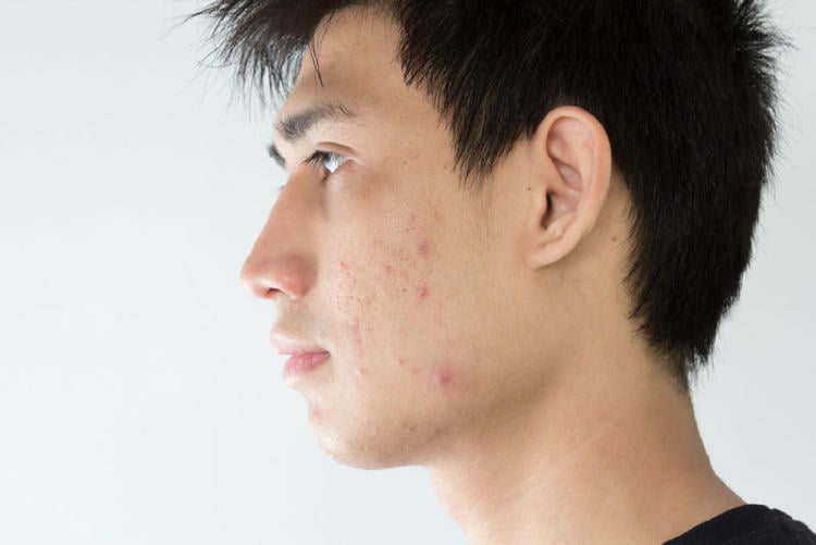 cómo quitar las espinillas cómo quitar las espinillas