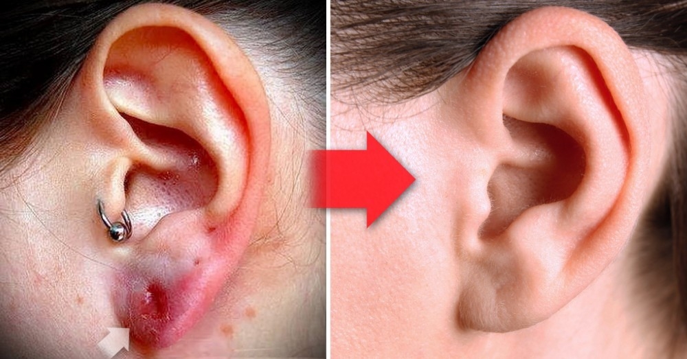 Aretes en la oreja: ¿Cómo curar oreja infectada aretes? | Bioguia