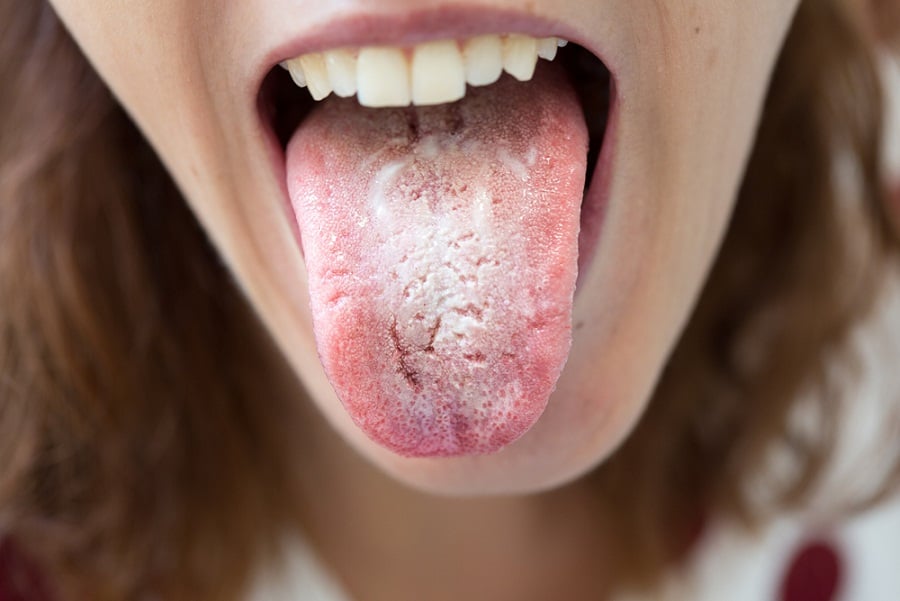 mujer con lengua blanca