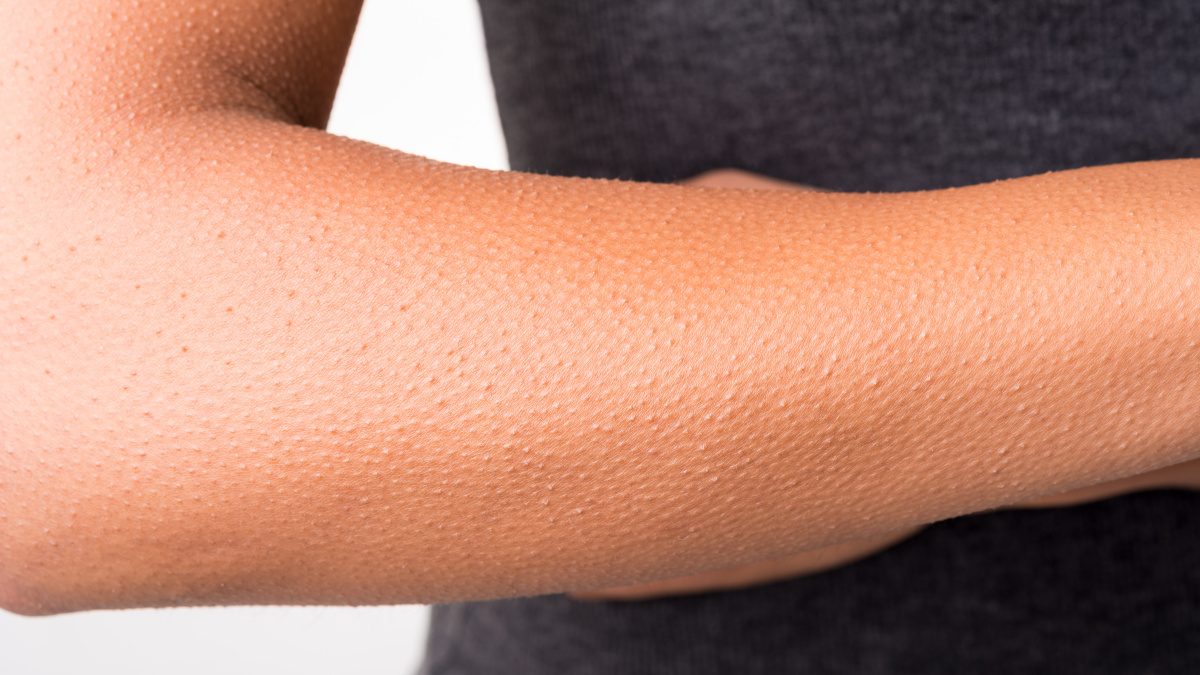 piel de gallina AdobeStock_48649906 piel de gallina AdobeStock_48649906