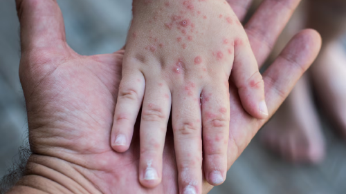 VIRUS NIÑOS El virus Coxsackie se transmite a través del contacto directo con las secreciones respiratorias o las heces de una persona infectada (Shutterstock)