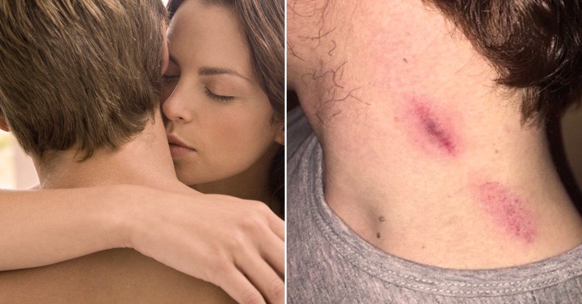 Chupeton en el cuello puede causar derrame cerebral Chupeton en el cuello puede causar derrame cerebral