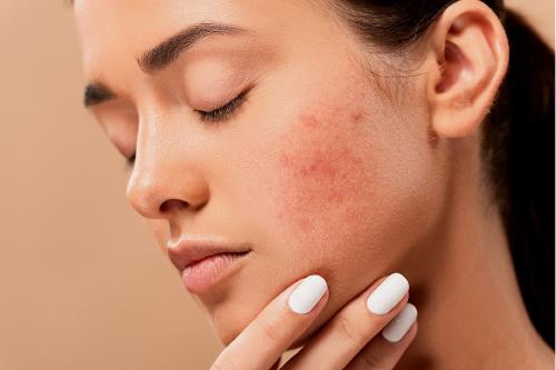Piel sin acné en una semana: ¿cómo lograrlo con remedios caseros y naturales?
