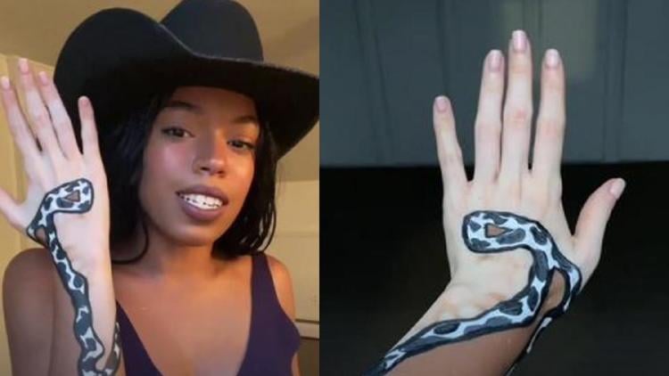 vitiligo3 vitiligo3