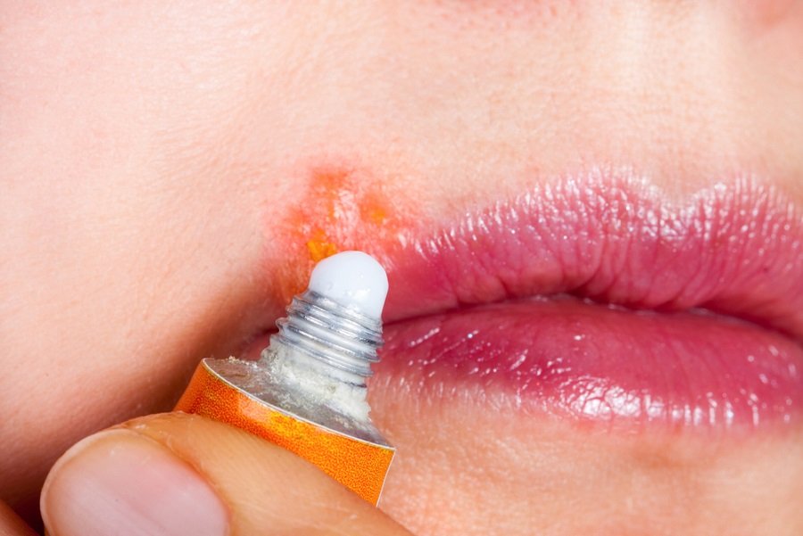 herpes bucal oral herpes bucal oral