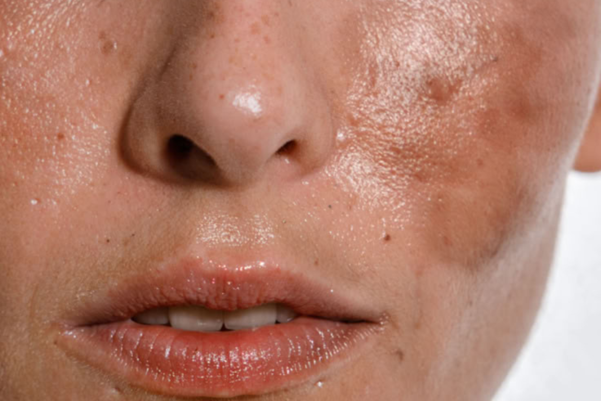 enfermedades piel Enfermedades graves como el cáncer de piel, dermatitis severa y afecciones autoinmunes están en aumento. ¿Cómo nos está afectando realmente el entorno? (Foto: Pinterest)