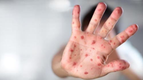 sarampion El sarampión representa la mayor preocupación para los jefes de la salud, quien indican que se ha presentado un aumento de los casos.. (FUENTE: msn)