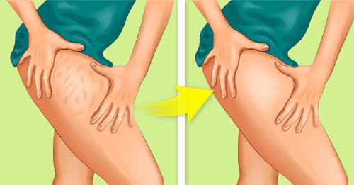 Celulitis: un abordaje natural en cuatro pasos