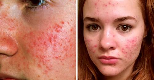 ¿Cuál tipo de acné tienes y cómo puedes tratarlo naturalmente? ¿Cuál tipo de acné tienes y cómo puedes tratarlo naturalmente?