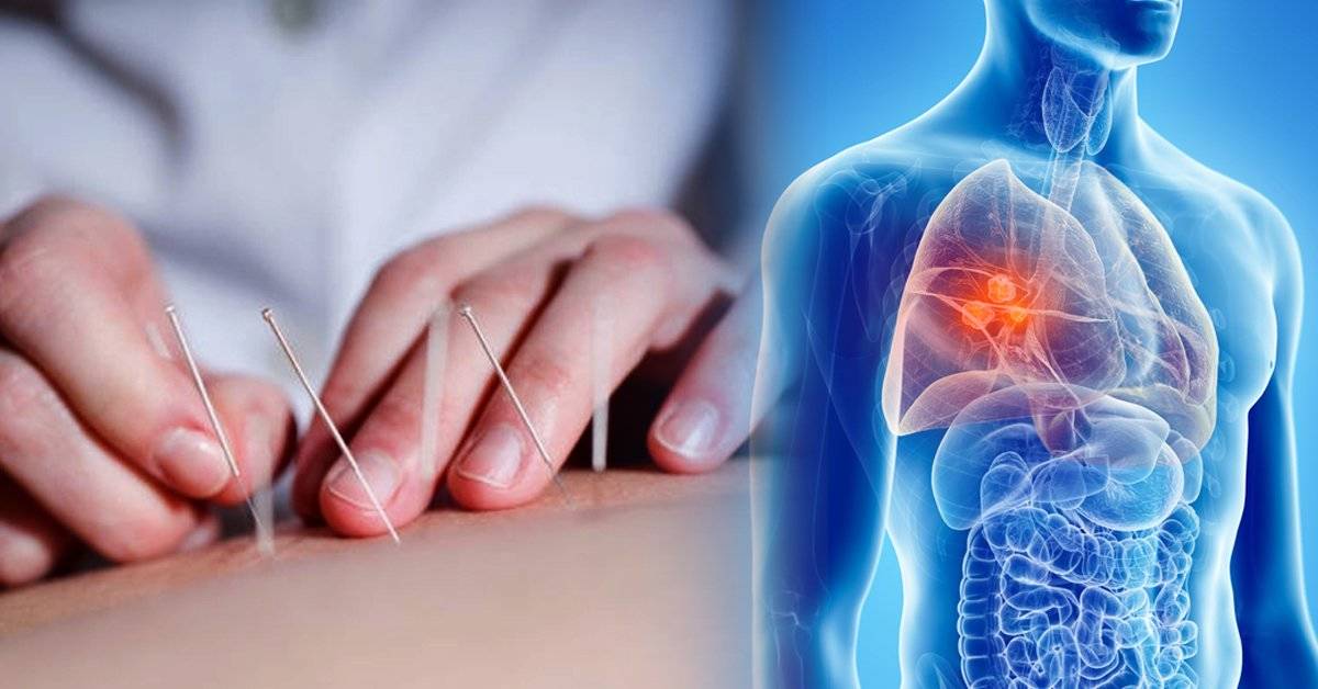 Los beneficios de la acupuntura para pacientes con cáncer