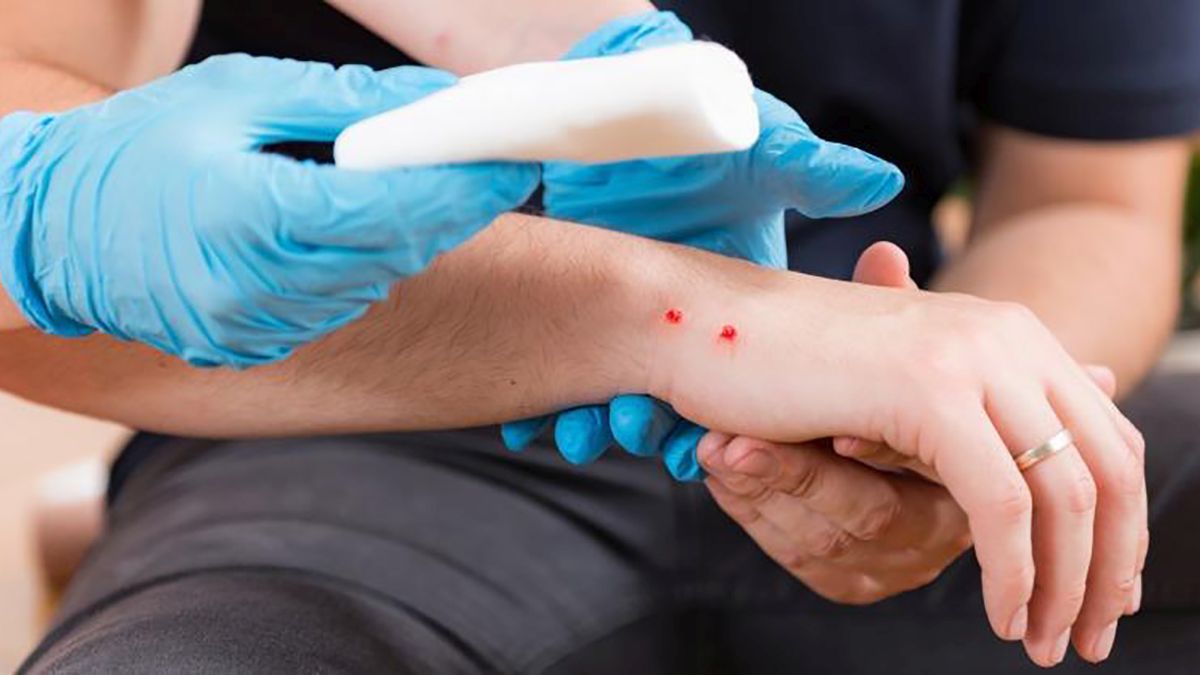 mordedura serpiente mordedura serpiente